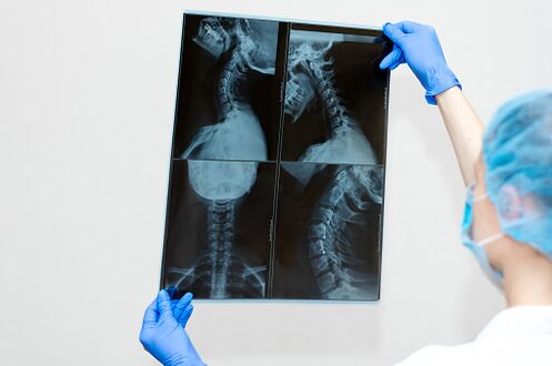 Doença espinhal de osteocondrose