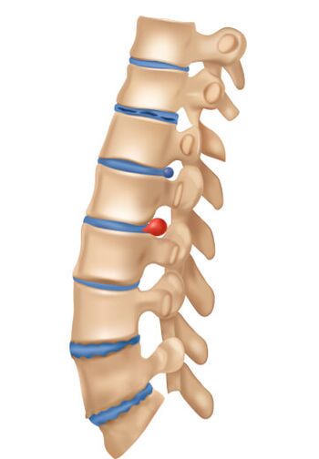 Como é a osteocondrose de deofrming