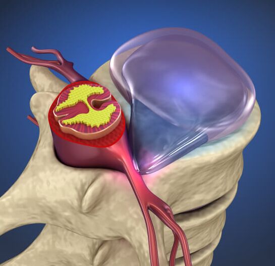 Hérnia intervertebral