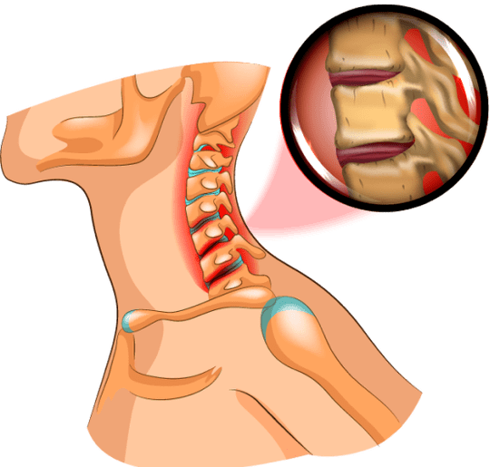 osteocondrose no pescoço
