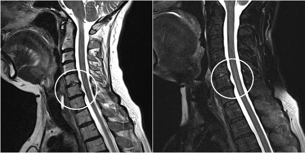 osteocondrose cervical em radiografia