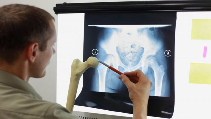 Médico examina um raio-x para artrose do quadril