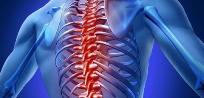 osteocondrose da coluna torácica